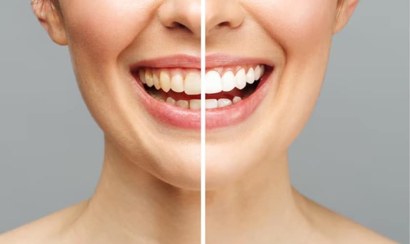 The Benefits of Teeth Whitening for Your Dental Health
