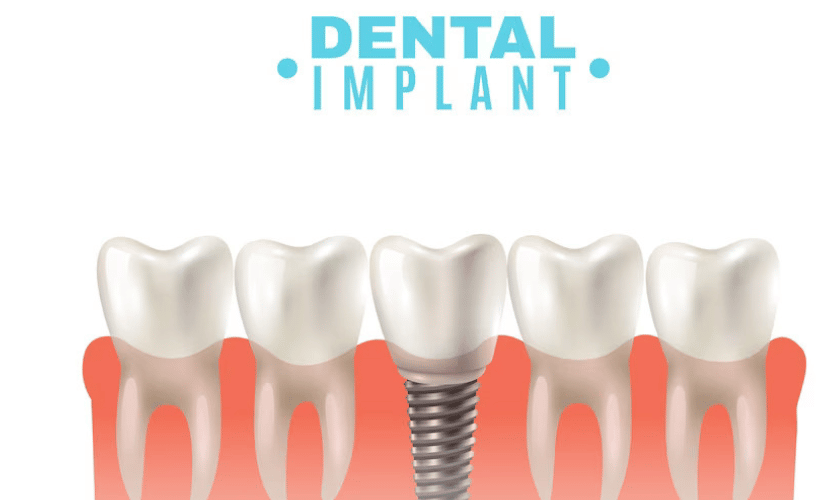 advantages of dental implant