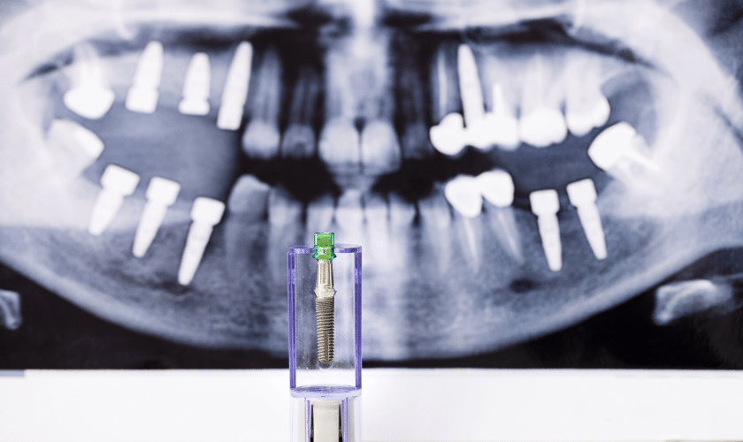 Dental Implants Can Improve Your Quality of Life
