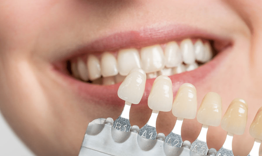 Should I Get Dental Implants Or A Bridge?