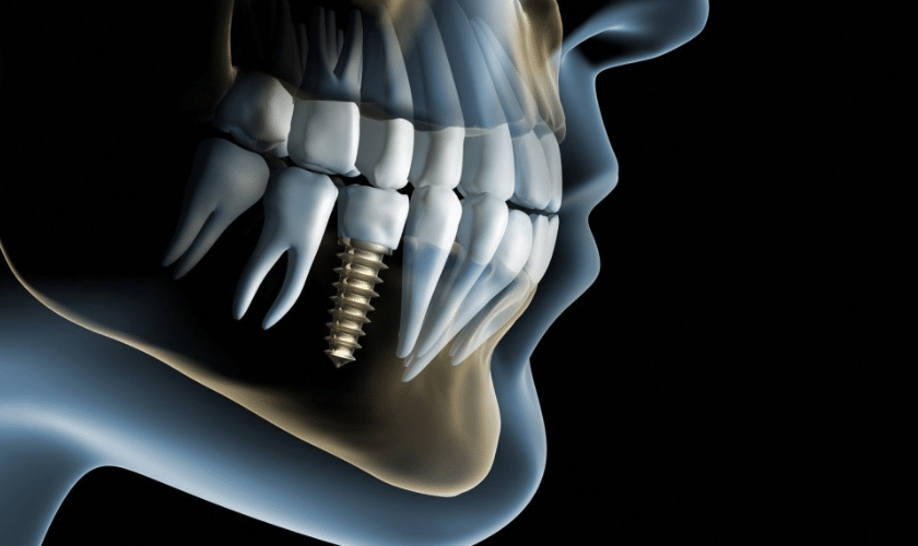 Featured image for “Is A Dental Implant For Molars The Suitable Choice For You? ”