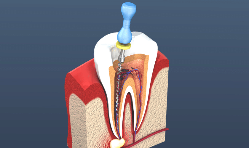 root canal in Yorkville
