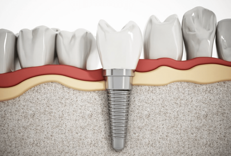 Dental Implant