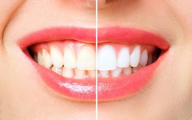 effective homemade teeth whitening solutions