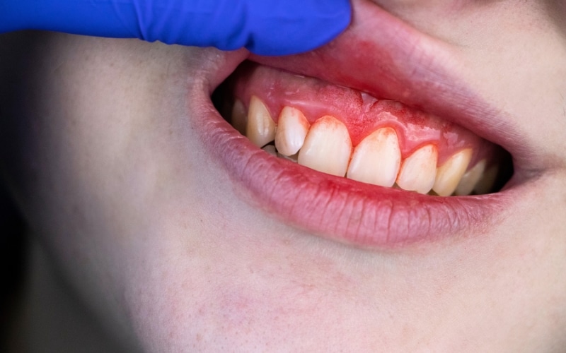 periodontal therapy for gum recession treatment