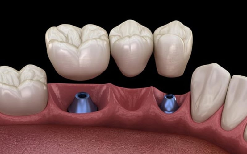 Can Smokers Get Dental Implants Risks