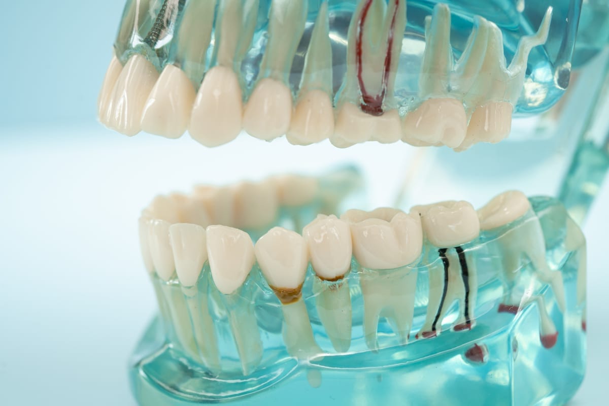 Featured image for “Root Canal vs. Extraction in Yorkville, IL | Prairie Garden Dental”